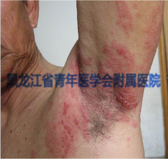 带状疱疹症状